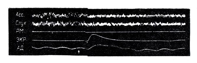 Рис. 4. Одновременное воздействие сенсорной стимуляции на кортикальные двигательные и вегетативные функции. Слуховой стимул (щелчок) вызывает реакцию пробуждения на электрокортикограмме (ассоциативная и слуховая кора), облегчение моносинаптического рефлекса (РМ), электрокожной реакции (ЭКР), повышение артериального давления (АД). Все эти влияния стимула на активирующую ретикулярную формацию осуществляются через посредство коллатералей центральных чувствительных путей. Прямое раздражение ретикулярной формации влечет за собой аналогичный эффект. (По Блоку В.)